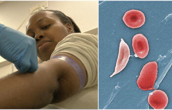 NHS Approves 'Life Changing' Sickle Cell Treatment In England
